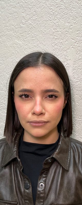 Depois — Toxina Botulínica