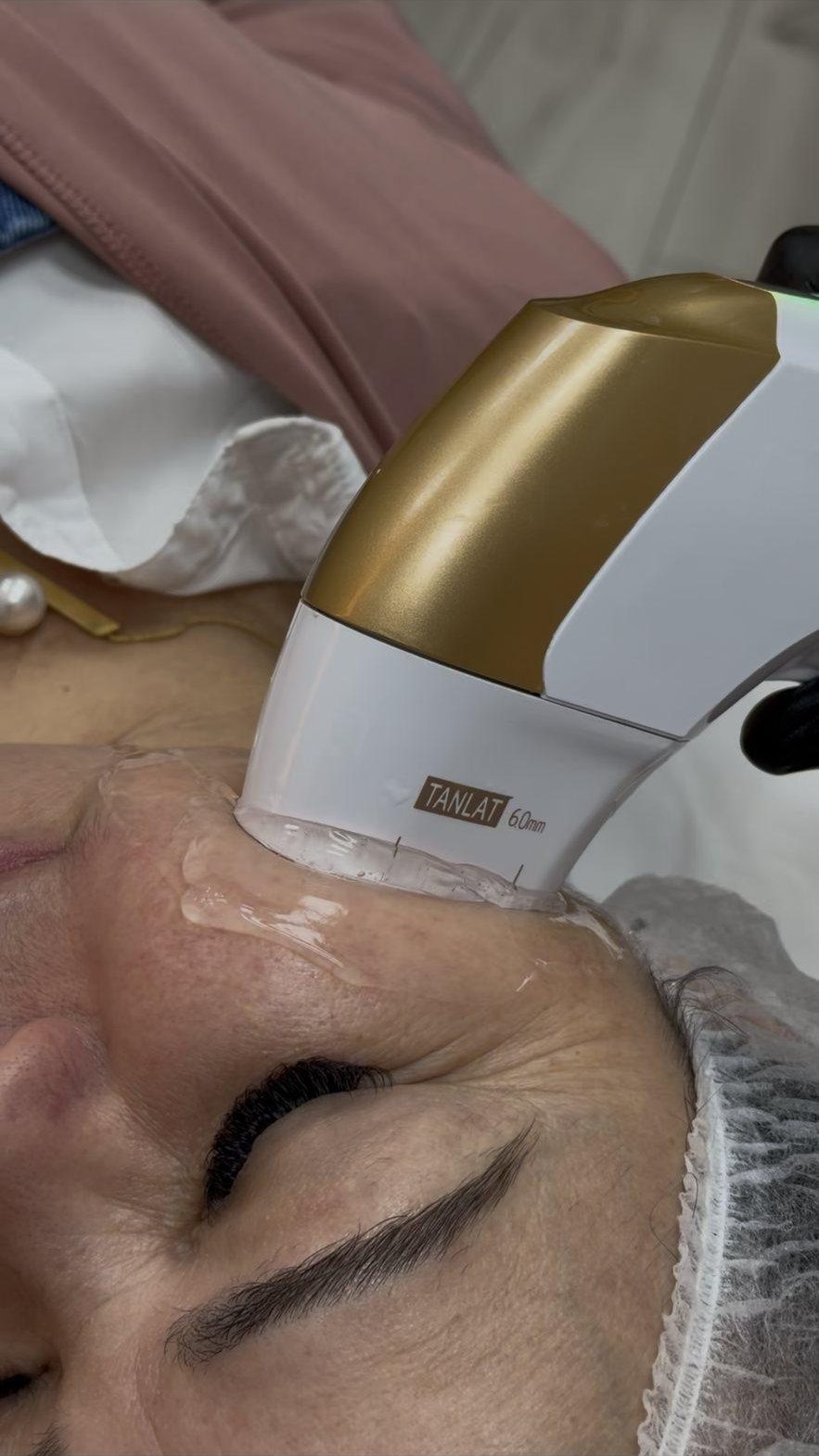 Aplicação de HIFU ultrassom microfocado no rosto em clínica de Orlando