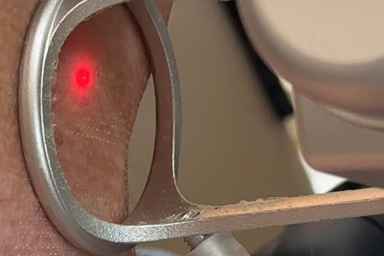 Procedimento de laser CO2 fracionado em Orlando na clínica EZ Aesthetics & Wellness