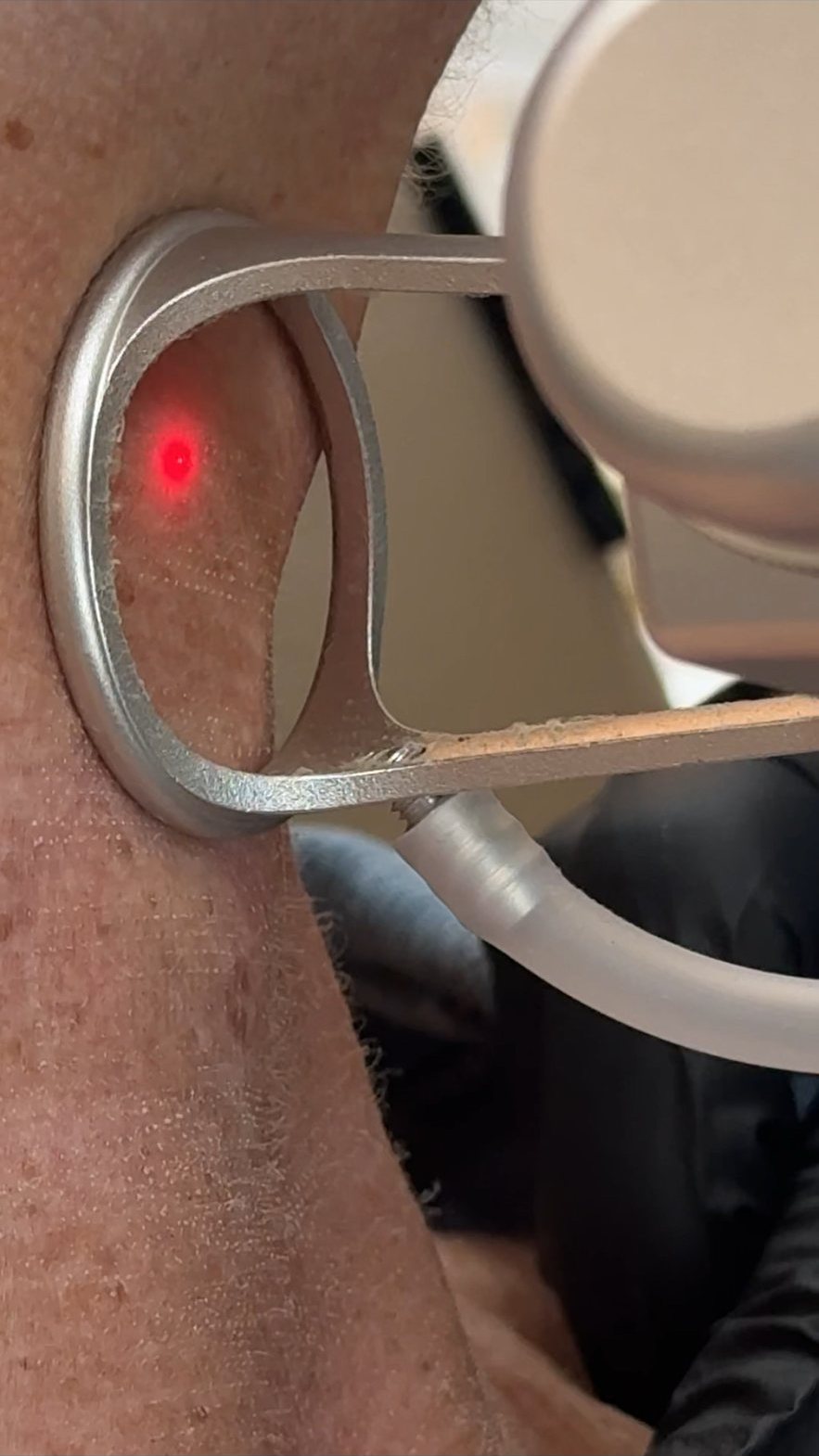 CO2 laser