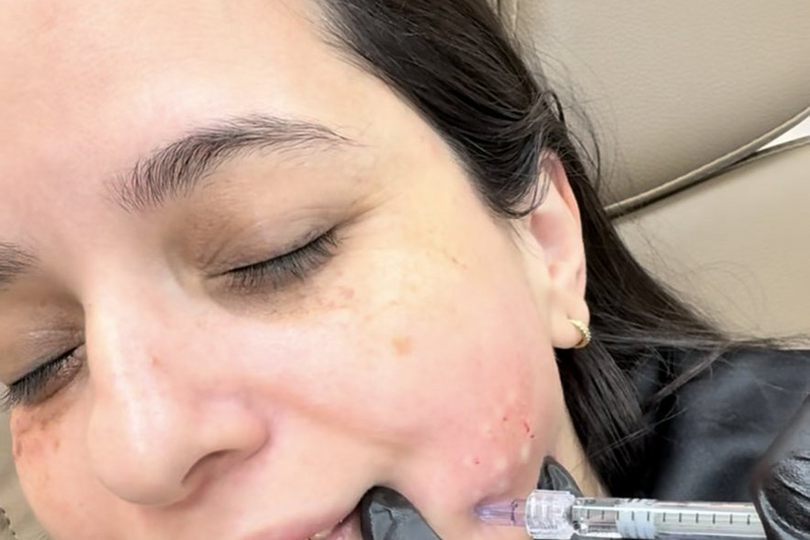 Facial mesotherapy treatment in Orlando at EZ Aesthetics & Wellness