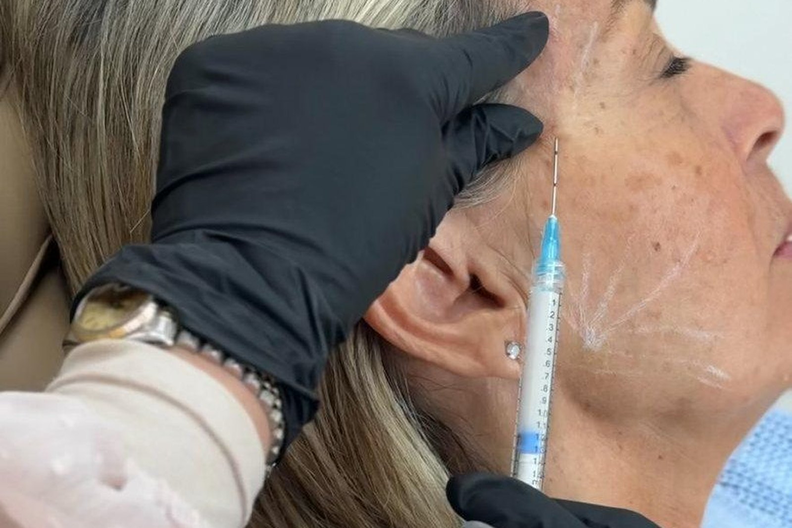 Aplicación de Sculptra bioestimulador de colágeno en clínica de medicina estética en Orlando