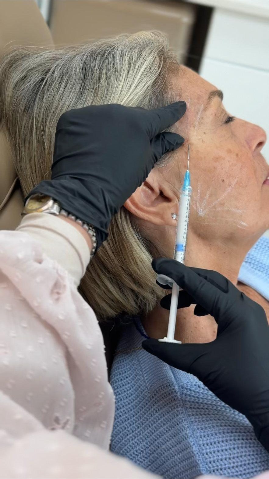 Aplicação de Sculptra bioestimulador de colágeno em clínica de medicina estética em Orlando