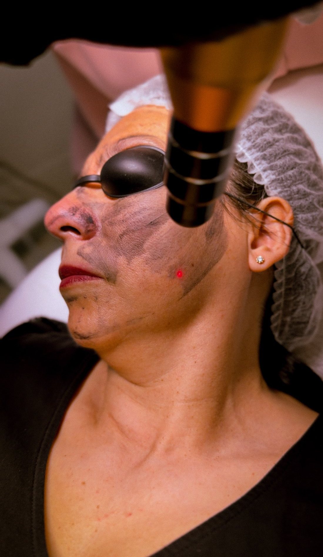 Chemical peel